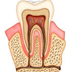 All about root canals 
